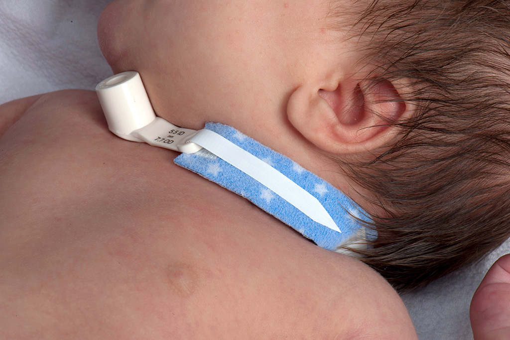 Soporte para Tubo de Traqueostomía